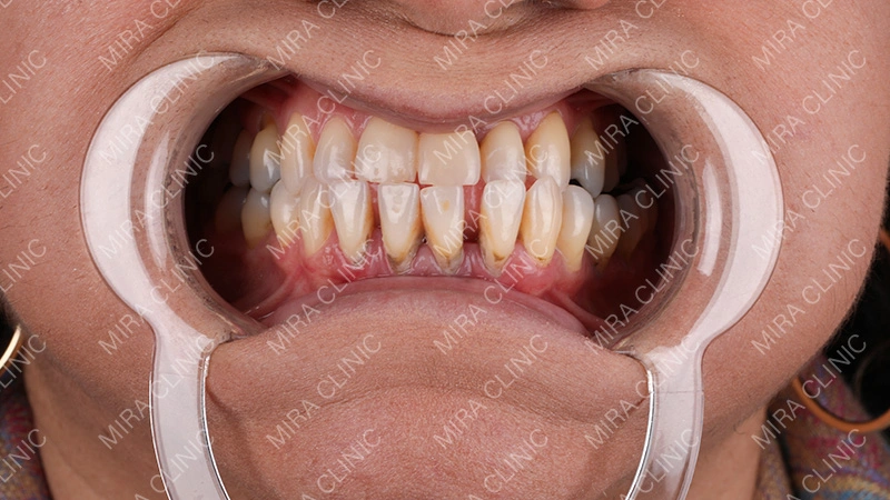 Smile Makeover patient experience